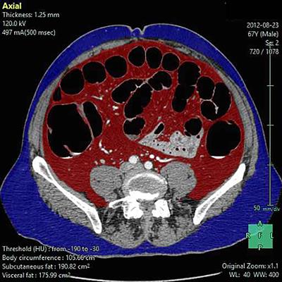 Obesity may not be related to pathologic response in locally advanced rectal cancer following neoadjuvant chemoradiotherapy